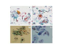 Presence of koilocytes in UC. A and B: 20×; C and D: 40×, optical microscopy, Papanicolaou staining. Images by Leon, RM UC: urine cytology test.