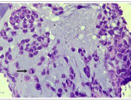 Imagem microscópica (400×) de metástase para o pulmão, com detalhe citológico da neoplasia, contendo mitoses (seta)