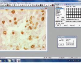 Image of screen capture of Image Pro Plus 6.0 software with the file of cells brown stained with Ki-67 antibody. Each field had the number of cells and the stained area counted. DAB dye, 400×