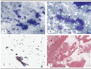 An illustrative case showing most habitual cellularity in different preparations
