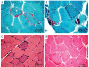 Ragged red fibers, hallmark of mitochondrial disorders, in modified Gomori