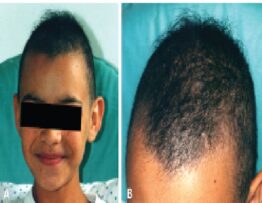 Images of the patient at 10 years of age showing diffuse and irregular alopecia with hair rupture at different levels, giving an appearance of hypotrichosis (A and B)