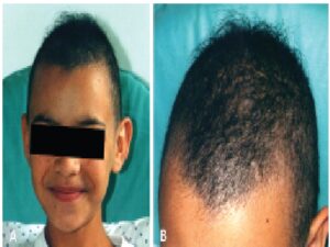 Images of the patient at 10 years of age showing diffuse and irregular alopecia with hair rupture at different levels, giving an appearance of hypotrichosis (A and B)