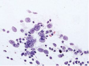 Papanicolaou method, 100× LSIL: low-grade squamous intraepithelial lesion.