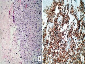 Metastasis of breast invasive ductal carcinoma in CNS parenchyma