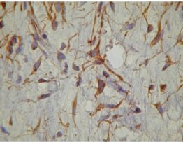 Immunohistochemistrystudy showing only positive tumor cells for vimentin (400×)