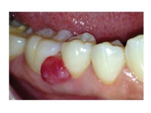 Reddish, sessile mass in the right vestibular mandibular gingiva between the second premolar and the first molar