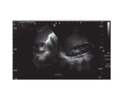 Dynamic US of the right kidney showing kidney size US: ultrasonography.