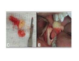 image showing the extension of the tissue associated with the dental element; B) intraoral images showing the moment of tooth 48 removal along with the altered tissue