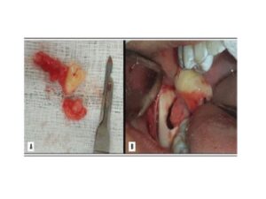 image showing the extension of the tissue associated with the dental element; B) intraoral images showing the moment of tooth 48 removal along with the altered tissue