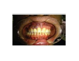 Clinical aspect Intraoral aspect of the patient, evidencing a purplish increased volume, located in the gingival region of the maxilla, in the area adjacent to the apex of the element 12.