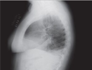 Lateral chest X-ray. Opacity in right lung base and in midfields and left lung base, due to air space filling lesions