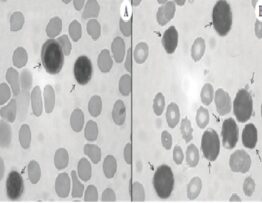 Morphology of B lymphoid precursors (arrows) in BM aspirate samples stained by May-Grünwald-Giemsa