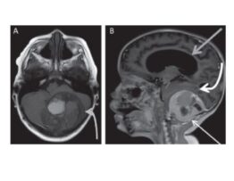 A) MRI in T1-weighted axial image without contrast demonstrating well-defined extra-axial mass in the posterior fossa (curved light gray arrow), projecting to the adjacent soft parts; B) MRI, T1-weighted post-contrast sagittal image demonstrating well-defined extra-axial mass in the posterior fossa traversing the posterolateral inferior occipital bone, projecting to the adjacent soft parts, with intense peripheral enhancement by contrast (fine white arrow), striking the cerebellar hemispheres (curved arrow) and distorting the fourth ventricle with severe hydrocephalus upstream (gray arrow) MRI: magnetic resonance imaging.