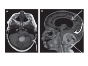 A) MRI in T1-weighted axial image without contrast demonstrating well-defined extra-axial mass in the posterior fossa (curved light gray arrow), projecting to the adjacent soft parts; B) MRI, T1-weighted post-contrast sagittal image demonstrating well-defined extra-axial mass in the posterior fossa traversing the posterolateral inferior occipital bone, projecting to the adjacent soft parts, with intense peripheral enhancement by contrast (fine white arrow), striking the cerebellar hemispheres (curved arrow) and distorting the fourth ventricle with severe hydrocephalus upstream (gray arrow) MRI: magnetic resonance imaging.
