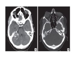 Aggressive papillary tumor of endolymphatic sac: CT showing an expansile lytic lesion arising in the right temporal bone (A and B) CT: computed tomography.