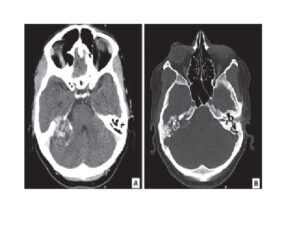 Aggressive papillary tumor of endolymphatic sac: CT showing an expansile lytic lesion arising in the right temporal bone (A and B) CT: computed tomography.