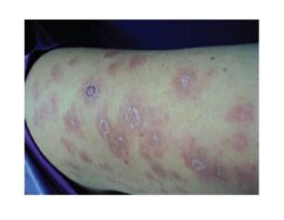 Clinical aspect of patient with metastatic cutaneous Crohn's disease: erythematous scaly plates in left arm