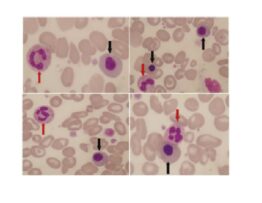 A peripheral blood smear (100×): Leishman's stain indicating leukoerythroblastic picture in a case of BMN. Black arrows show nucleated erythrocyte precursors, with red arrows indicating granulocytes BMN: bone marrow necrosis.