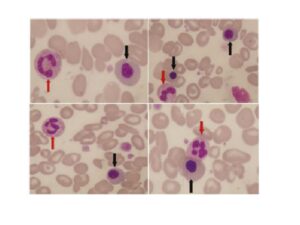 A peripheral blood smear (100×): Leishman's stain indicating leukoerythroblastic picture in a case of BMN. Black arrows show nucleated erythrocyte precursors, with red arrows indicating granulocytes BMN: bone marrow necrosis.