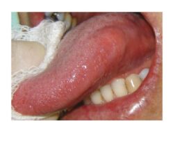 Submucous nodule on the left lateral border of the tongue