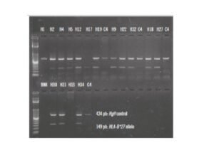 Band pattern of positive and negative samples for HLA-B*27 by PCR-SSP in agarose gel with standardized mix PCR-SSP: polymerase chain reaction-single specific primer; HLA: human leukocyte antigens; H: HLA-B*27 positive; C: HLA-B*27 negative; BNK: blank. Step ladder: 50 pb.