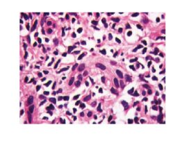 Native liver with chronic hepatitis C: ductal degeneration – cytoplasmic eosinophilia and loss of nuclear polarization (1,000×)