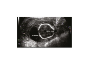 Fetal ultrasound performed at 16 weeks of gestation showing the cystic hygroma