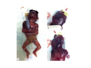 Postnatal appearance of the fetus showing the umbilical cord attached to the cephalic pole, in the area cerebrovasculosa (A-C). Along with these structures the presence of a fibrous tissue (see arrow) was also identified, what raised the possibility of an amniotic band (C)