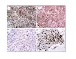 Immunohistochemistry: A) positive expression of CD99 marker; B) positive expression of CD56 marker; C) positive expression of CD57 marker; D) Ki-67 marker expression in 70% of tumor cells