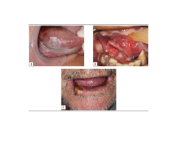 Main sites affected of 80 OSCC cases diagnosed at the ISNF/UFF Oral Pathology Laboratory