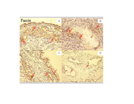 Nasal tissues of patients with CRSsNP and CRSwNP were immunostained with fascin antibodies