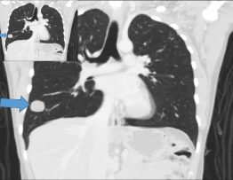 Lung nodule located in lower right lung measuring 2,6 cm on computed tomography scan.