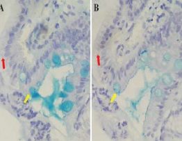 Presence of sialo or sulfomucins in the Goblet cells with Alcian Blue at pH 2.5 but Columnar cells not (A). Confirmation of sulfomucins in the Goblet cells with Alcian Blue at pH 0.5 but Columnar cells not (B). Interpretation of the algorithm: Intestinal Metaplasia-Type I. Red arrow: Columnar Cell. Yellow arrow: Goblet cell. Objective: 40X.