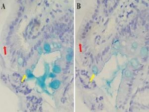 Presence of sialo or sulfomucins in the Goblet cells with Alcian Blue at pH 2.5 but Columnar cells not (A). Confirmation of sulfomucins in the Goblet cells with Alcian Blue at pH 0.5 but Columnar cells not (B). Interpretation of the algorithm: Intestinal Metaplasia-Type I. Red arrow: Columnar Cell. Yellow arrow: Goblet cell. Objective: 40X.