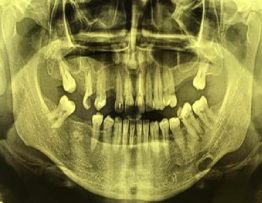 Panoramic radiograph showing Stafne's bone defect on the left side of the mandible.