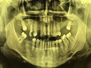 Panoramic radiograph showing Stafne's bone defect on the left side of the mandible.